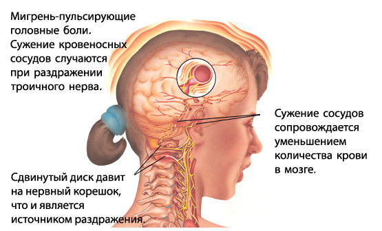 migrainerus